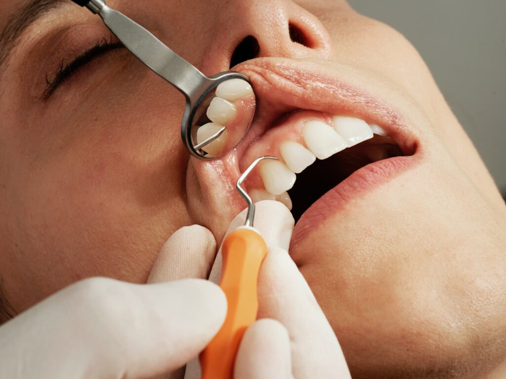 Hvordan unngå hull i tennene